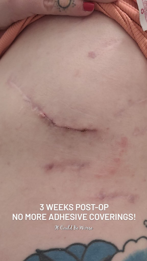 Slipping Rib Syndrome - Hansen Technique & One Month Follow-Up