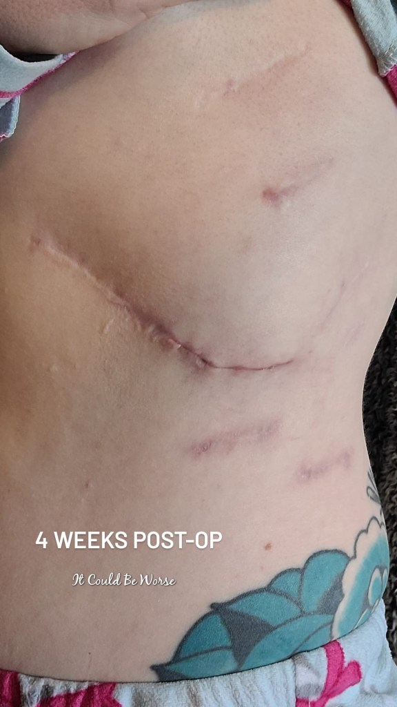 Slipping Rib Syndrome - Hansen Technique & One Month Follow-Up