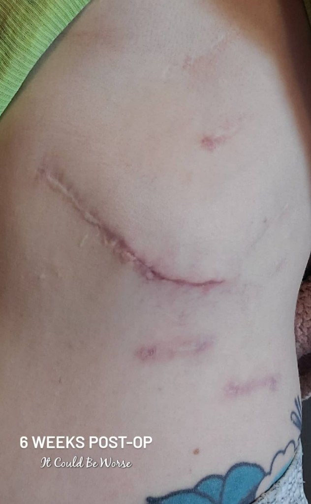 Slipping Rib Syndrome - Hansen Technique & One Month Follow-Up