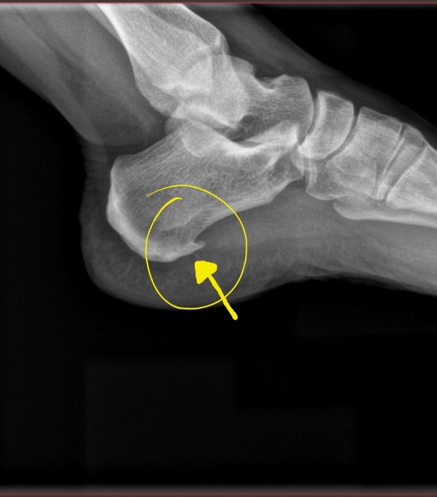 Pain in the Neck - It Could Be Worse Blog - Heel Spur - X-ray - Mary Horsley