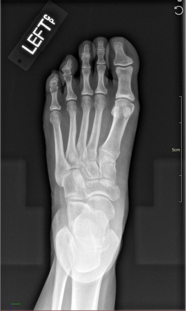 Pain in the Neck - It Could Be Worse Blog - Heel Spur - X-ray - Mary Horsley