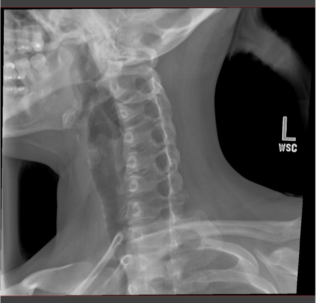 Pain in the Neck - It Could Be Worse Blog - Degenerative Disc Disease - X-ray
