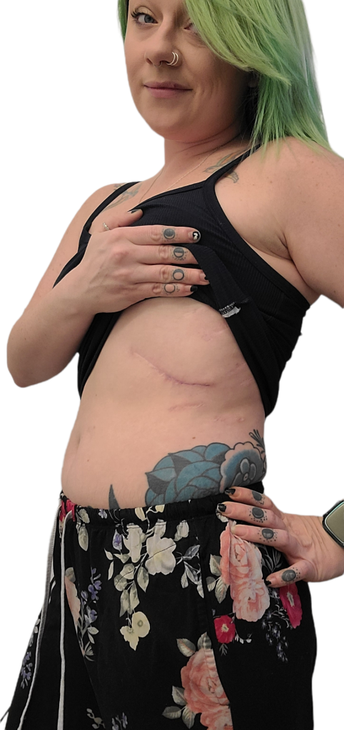 Slipping Rib Syndrome - 3 Months Post-Op and Scheduled for Another Surgery

