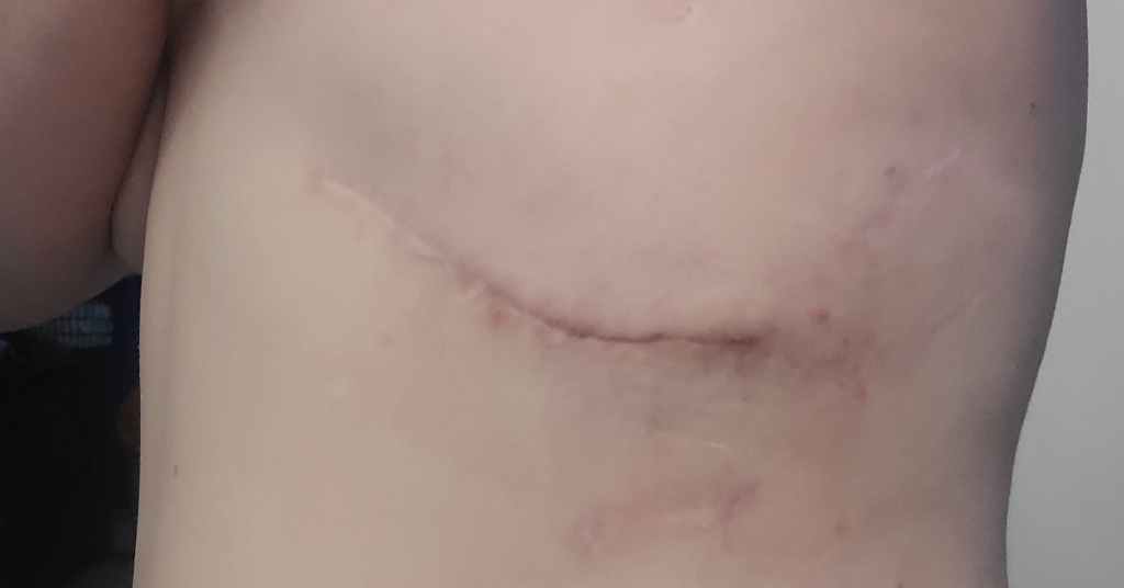 Slipping Rib Syndrome - 3 Months Post-Op and Scheduled for Another Surgery

