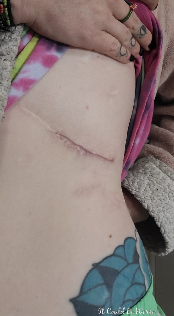 Slipping Rib Syndrome - 7th Procedure - 1 Month Post-Op