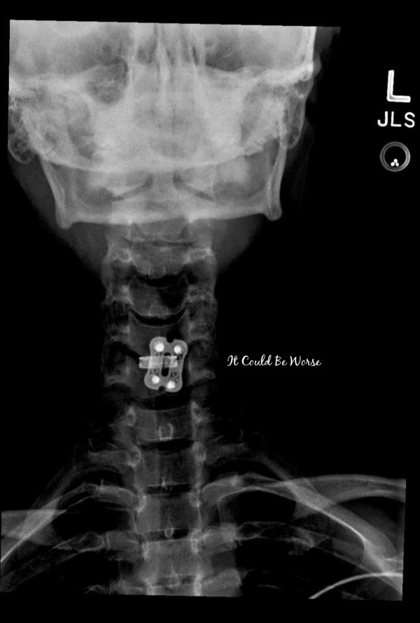 ACDF Surgery  - 3 Weeks Post-Op & X-rays