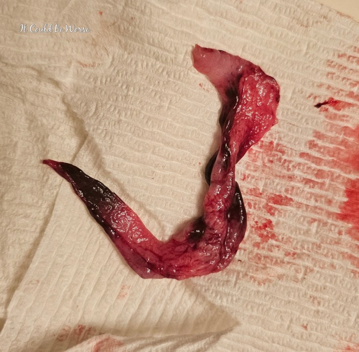 Decidual Casts & Birth Control