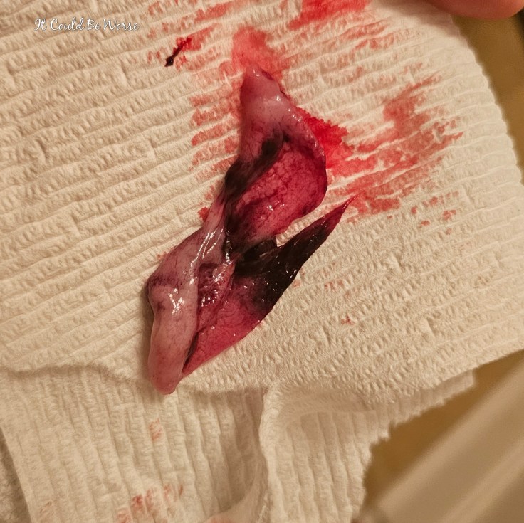 Decidual Casts & Birth Control